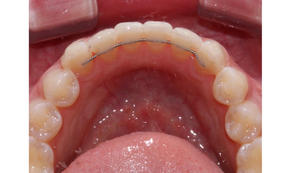 반포치과 뻐드렁니교정 방법은? 관련 이미지 12