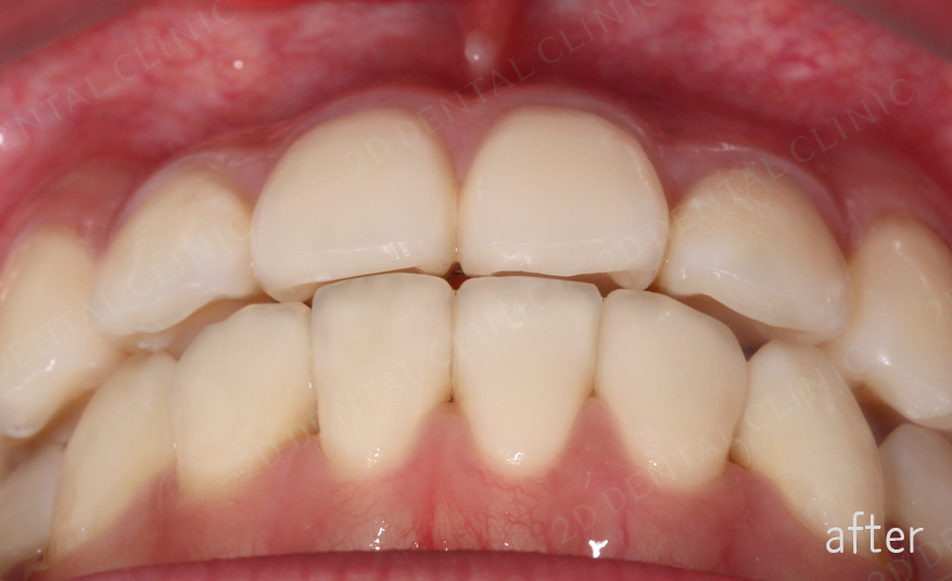 우디의 교정일기ㅣ덧니 치아교정 후기 (feat.부정교합) 관련 이미지 9