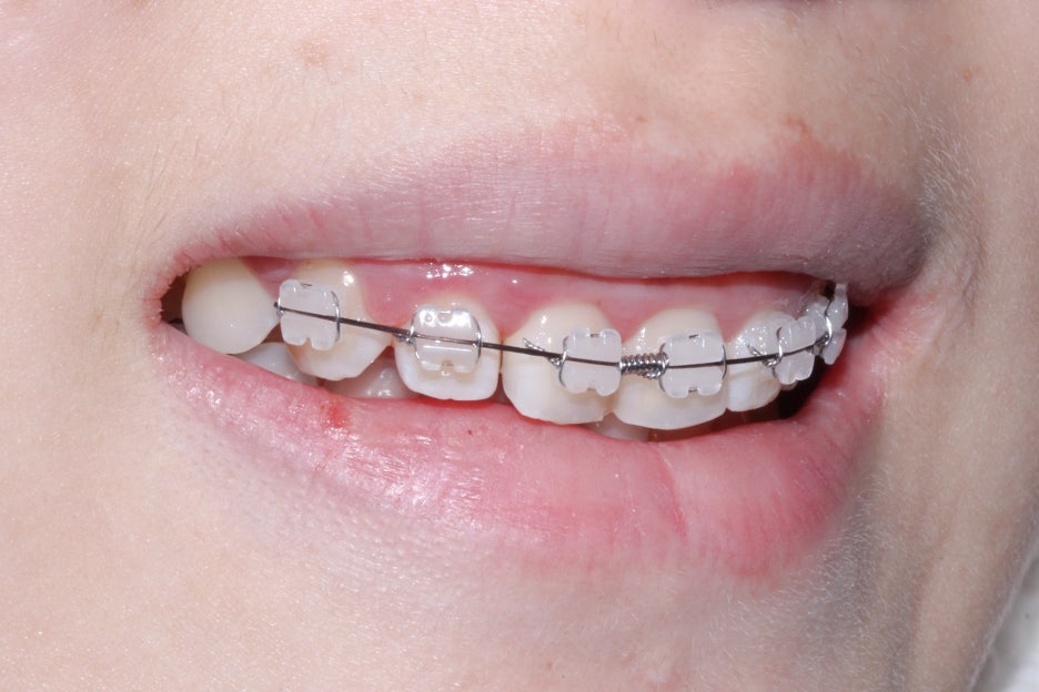 옥니교정 방법! 세라믹교정 Case 관련 이미지 7