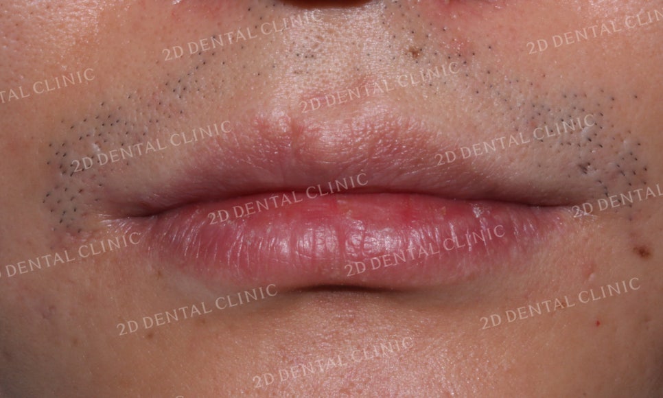 [2D교정] 나비치아교정을 2D교정 장치로 빠르게 완성하기! by.2D치과(투디치과) 관련 이미지 8