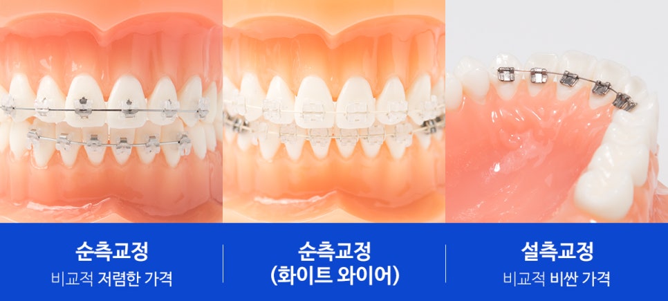 [투디(2D)치과] 순수교정, 화이트 와이어와 미백의 만남 관련 이미지 3