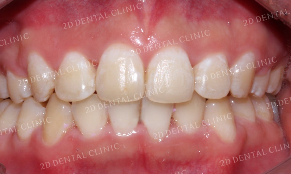 돌출앞니 교정, 튀어나온 입을 넣어보자! by.투디치과(2D치과) 관련 이미지 17