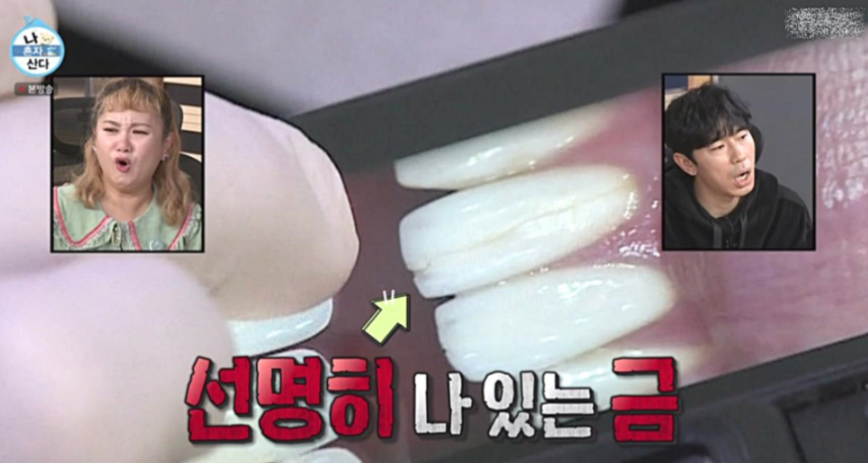 연예인라미네이트 치아삭제단점 보완한 치아삭제 없는 블랙필름 관련 이미지 4