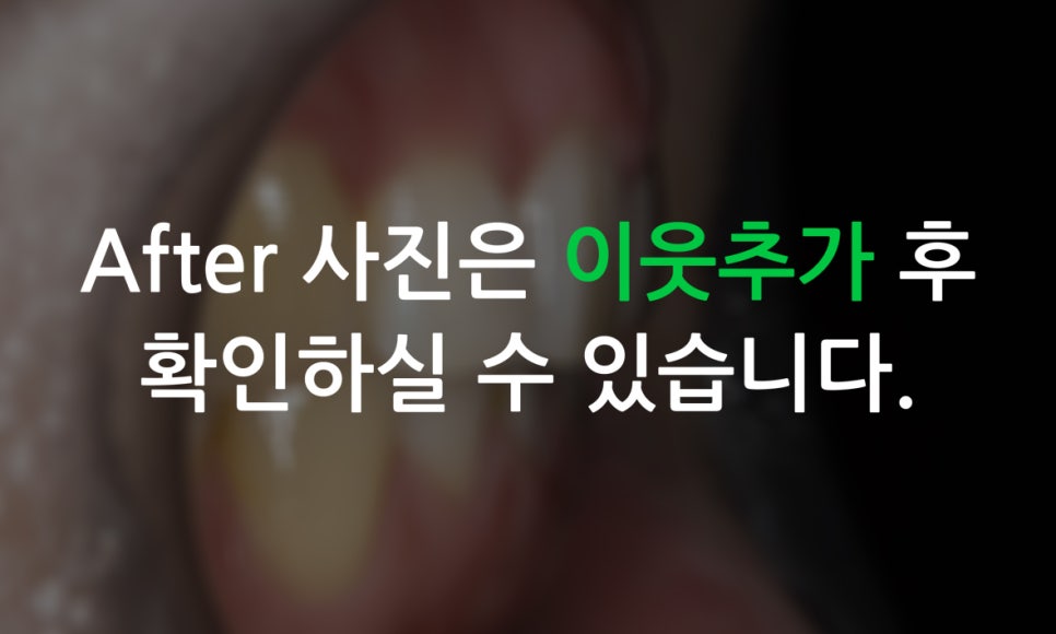 덧니교정 2D교정 (부분교정) 후기 관련 이미지 13