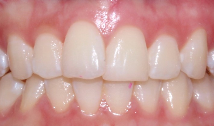 [신논현역치과] 앞니돌출 2D교정으로 개선! 관련 이미지 2