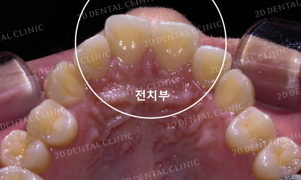 토끼앞니, 튀어나온 앞니 부분교정 후기! by.투디치과(2D치과) 관련 이미지 4