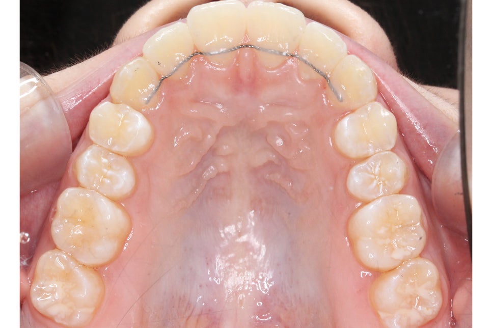 투디치과 송곳니덧니 치료 후기 관련 이미지 13