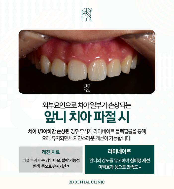 라미네이트무삭제 치아깨짐에도 자연스럽게 관련 이미지 3