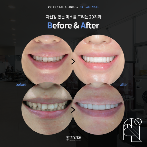 라미네이트 시술 전, 이것만은 꼭 확인하세요! 관련 이미지 7