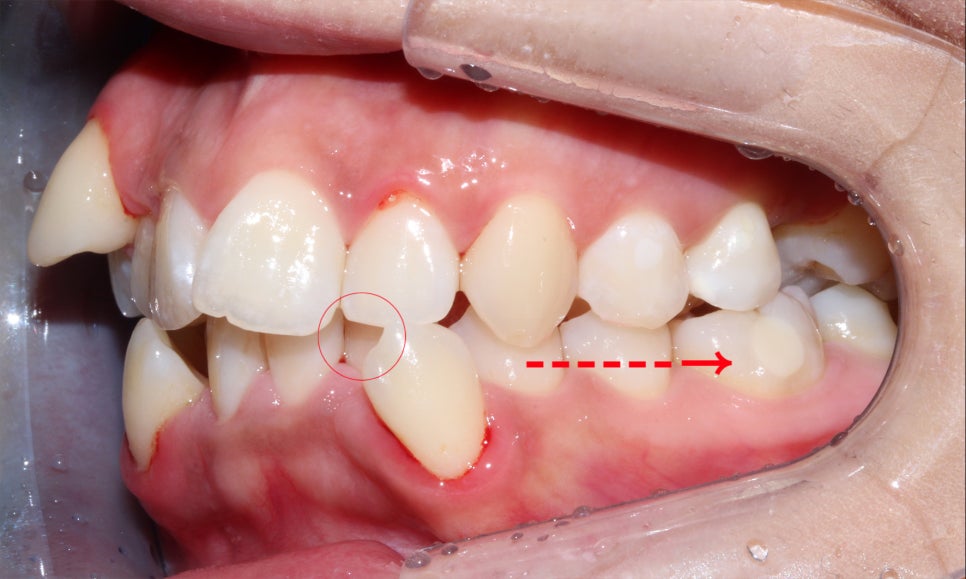 crowding 송곳니덧니 세라믹교정 방법 관련 이미지 6