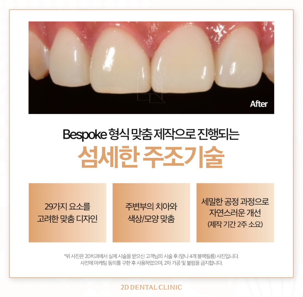 무삭제라미네이트가격 치아미백치과 앞니 고민 있다면 관련 이미지 6