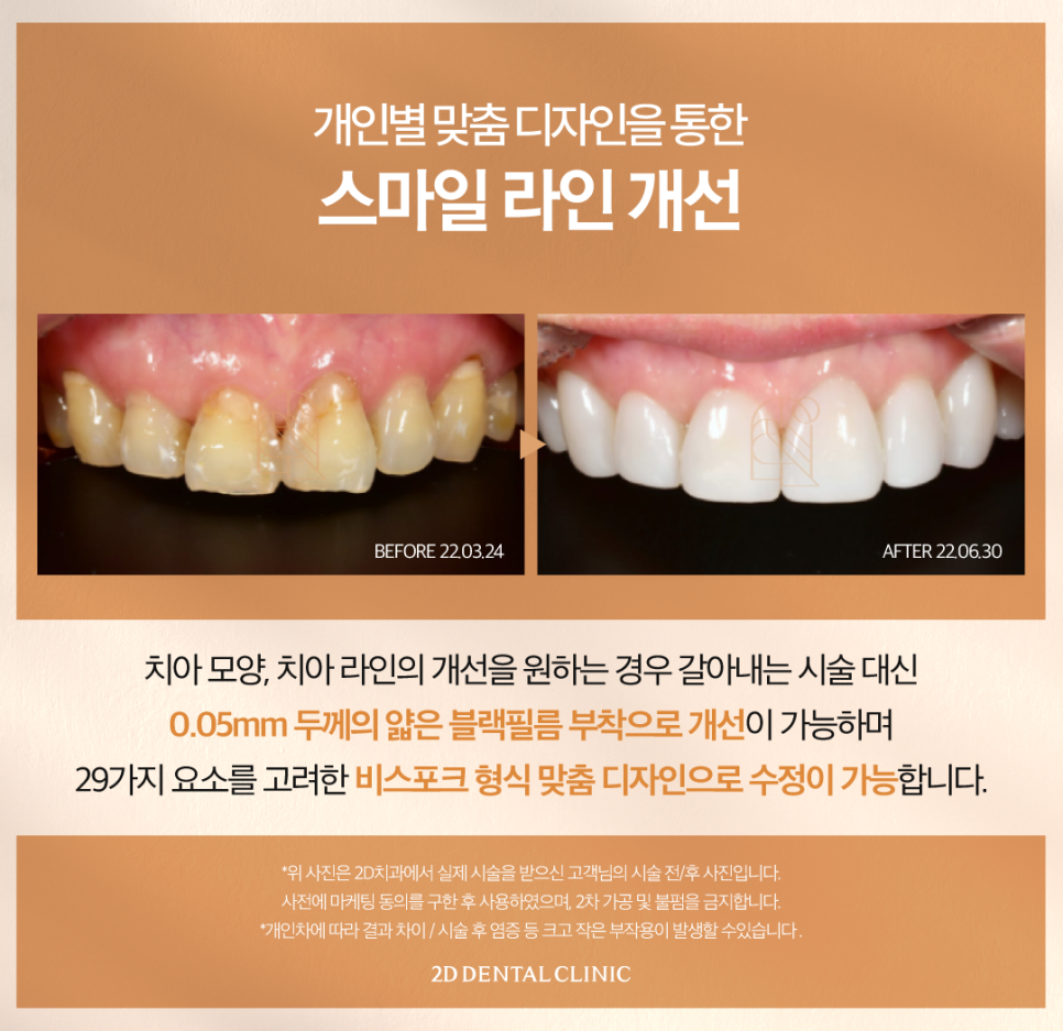 토끼이빨라미네이트 앞니심미치료로 자신 있게 웃어보세요! 관련 이미지 5