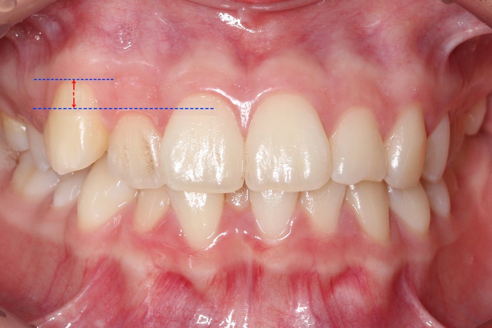 투디치과 송곳니덧니 치료 후기 관련 이미지 1