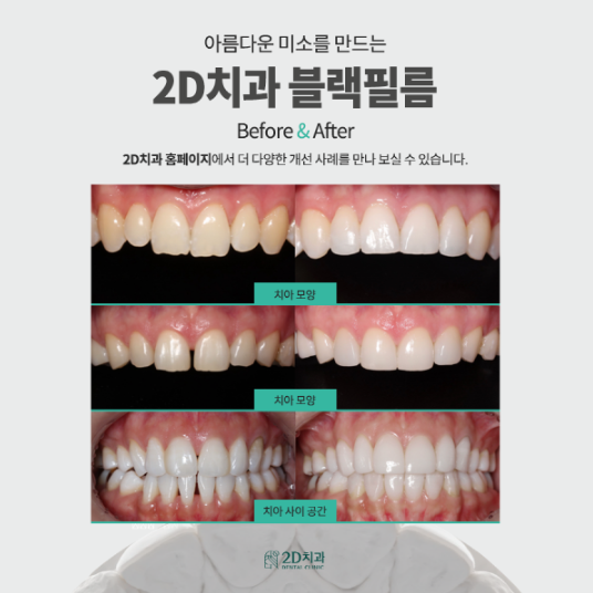 강남치과 블랙필름 무삭제라미네이트비용 관련 이미지 8