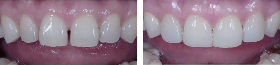 깨진 치아, 벌어진 치아 전부 관련 이미지 7
