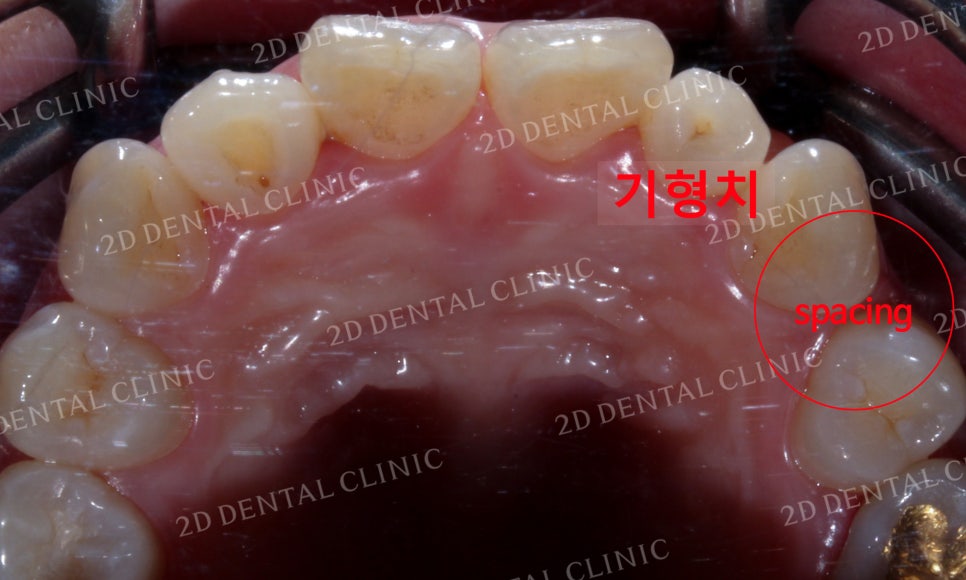 나비치아교정, 부분교정으로 나비치아 탈출하기! by.투디치과(2D치과) 관련 이미지 16