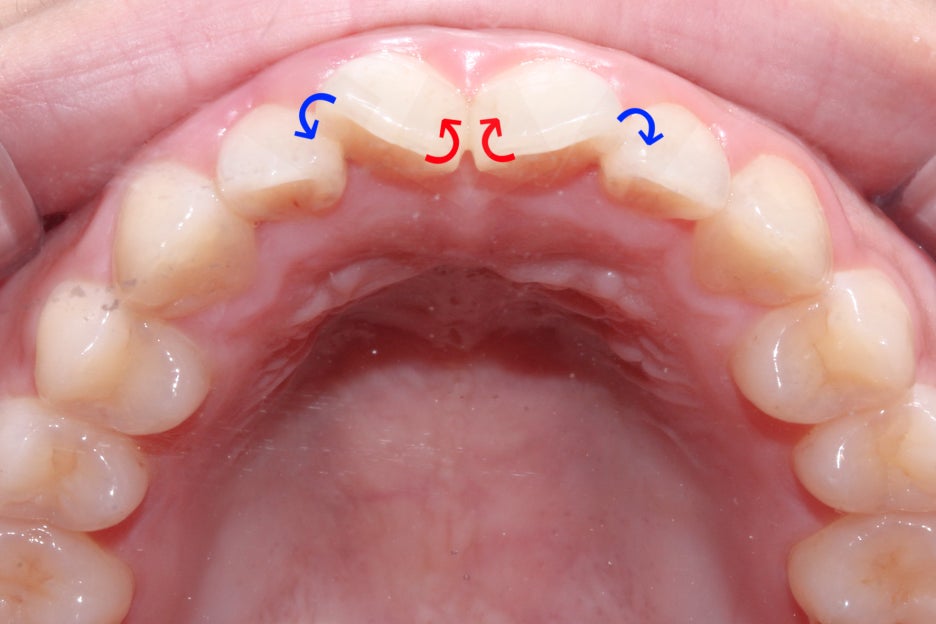 옥니교정 방법! 세라믹교정 Case 관련 이미지 4