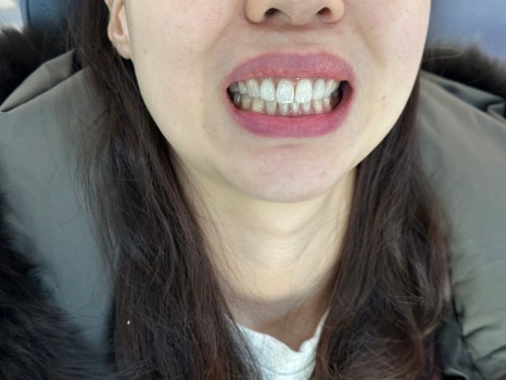 무삭제라미네이트 블랙필름 케이스 비포 에프터 후기 관련 이미지 7