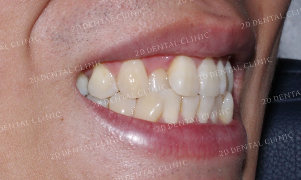 [앞니교정]부정교합교정, 부분교정으로 완성하기! by.투디치과(2D치과) 관련 이미지 4