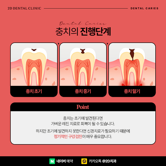 어금니충치치료 빠르게 진행해야 이유, 단계별 레진, 인레이, 크라운 순서 관련 이미지 3