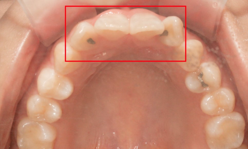 세라믹교정 앞니틀어짐 교정 사례 관련 이미지 7