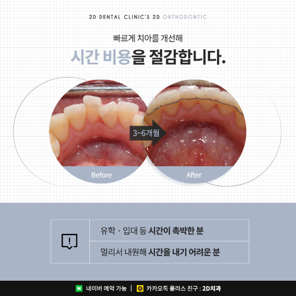 앞니가 고민이라면? 답은 <2D교정> 관련 이미지 6