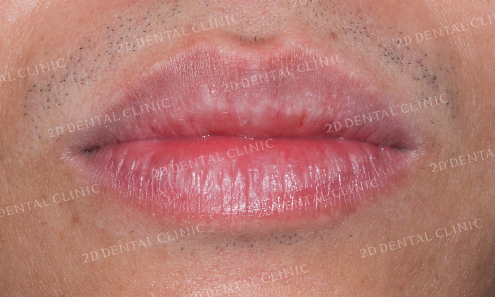 [앞니교정]부정교합교정, 부분교정으로 완성하기! by.투디치과(2D치과) 관련 이미지 8