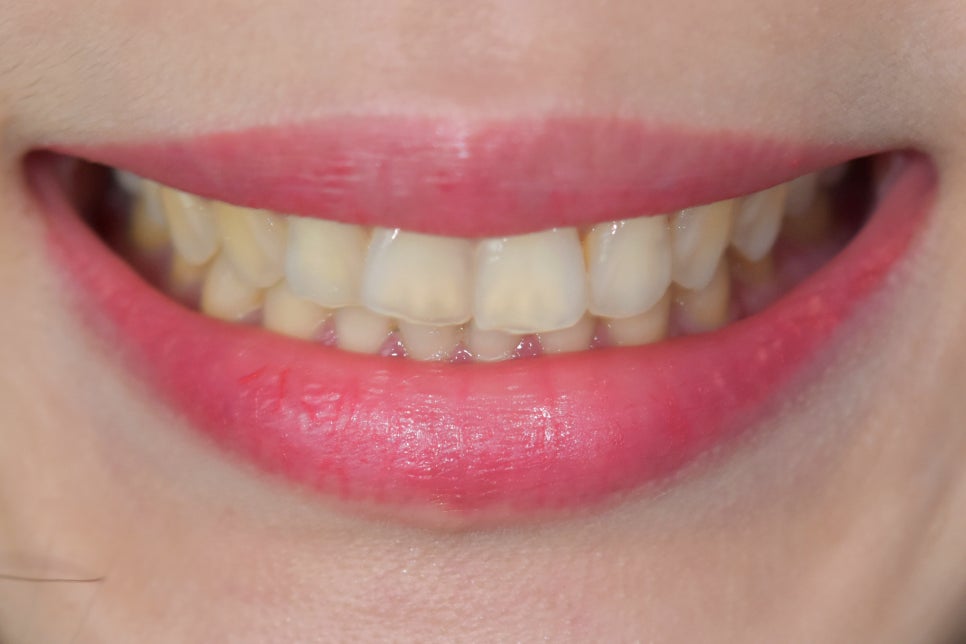 연예인라미네이트 무삭제로 잘하는 2D치과 관련 이미지 9