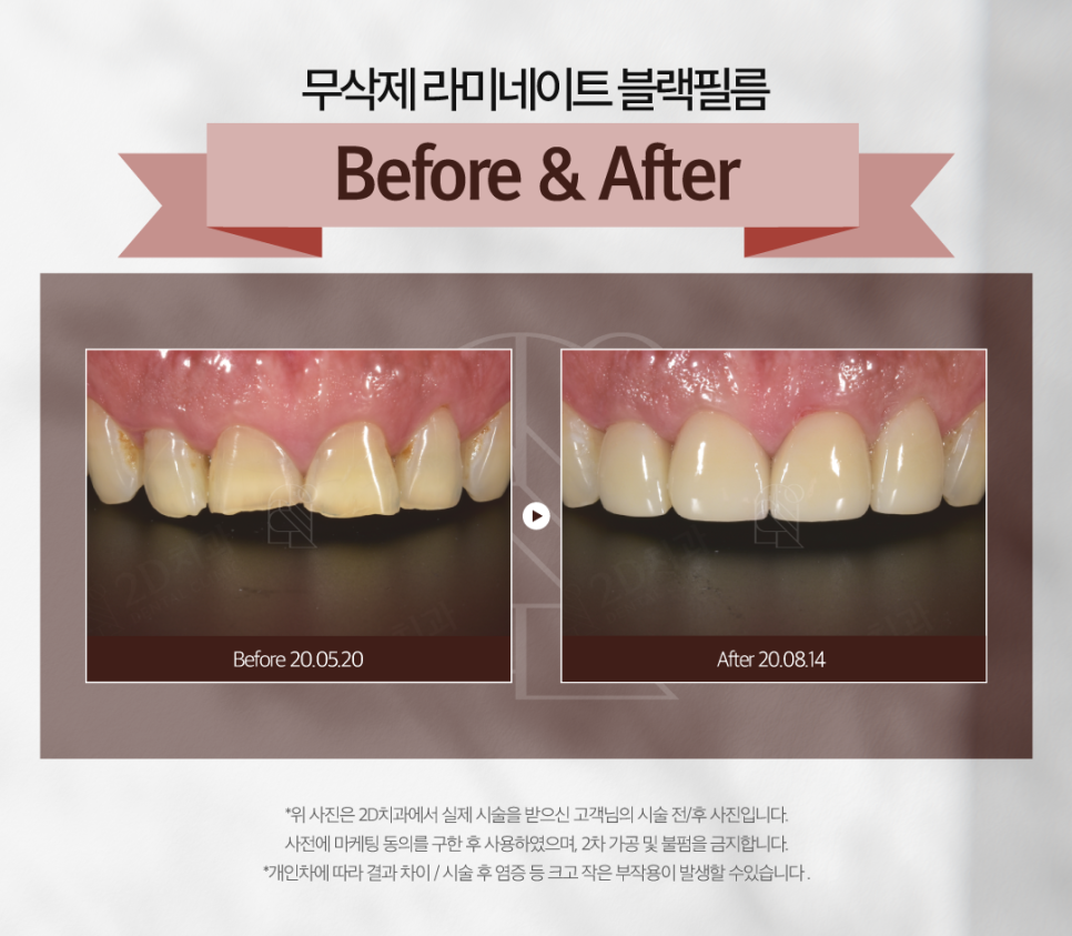 라미네이트제거 치아시림 튼튼한 상태로 유지할 수 있도록 관련 이미지 8