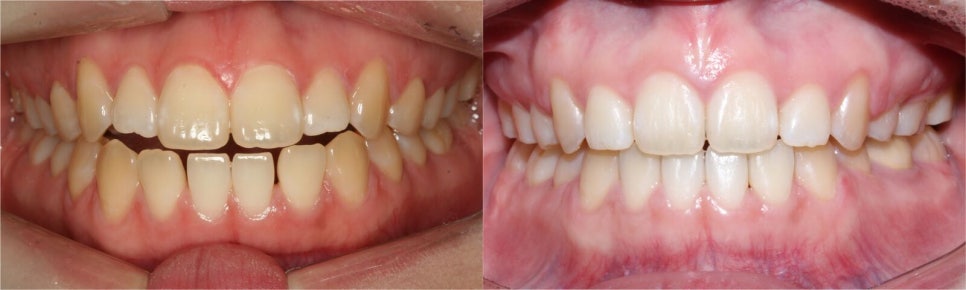 [2D치과]개방교합(Open bite)이란? 관련 이미지 1