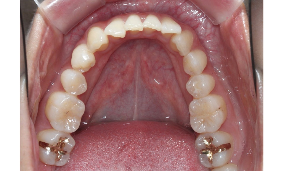 신논현치과 자가결찰브라켓 장점 관련 이미지 8