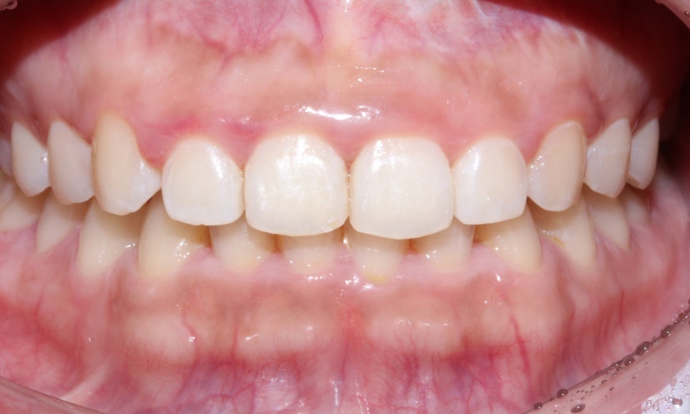 라미네이트에서 중요한 것은..심미적 요소, 블링스 관련 이미지 6