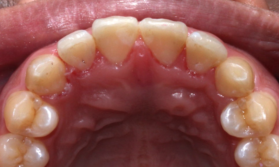 뻐드렁니 교정, 강남역치과에서 앞니 부분 교정한 후기! 관련 이미지 12