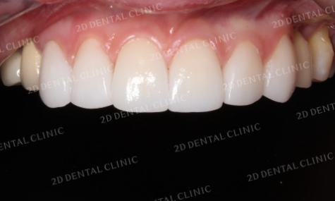 강남라미네이트병원 치아삭제 없는 무삭제치아성형 블랙필름 관련 이미지 7