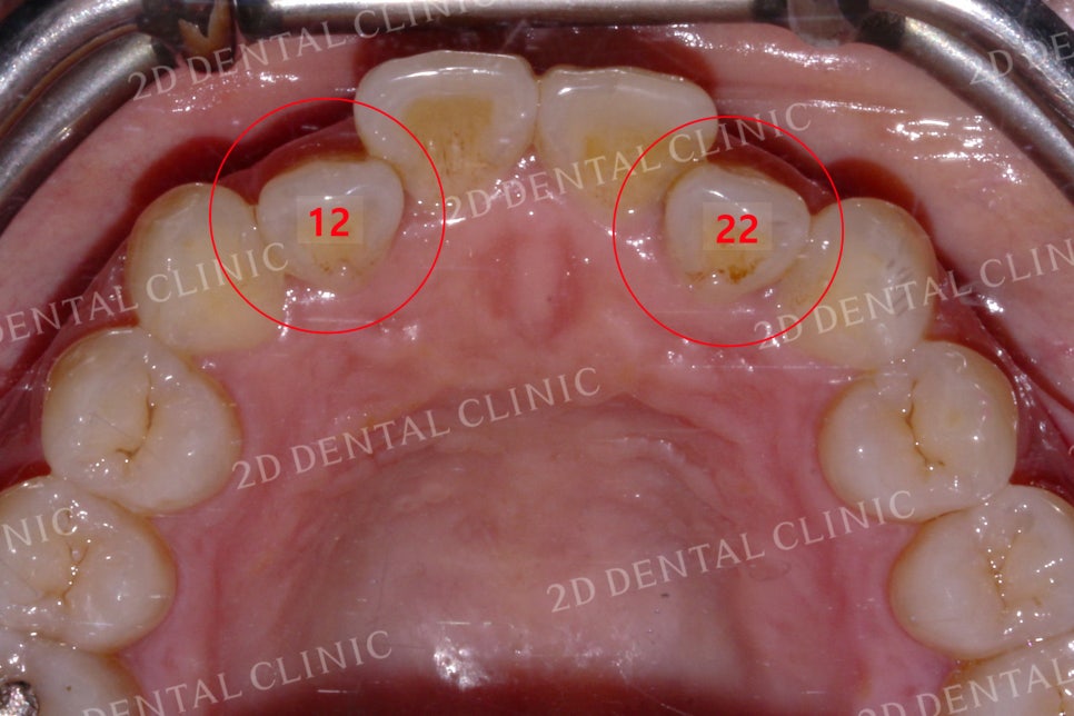 반대교합으로 물리는 치아를 바른 교합으로 교정하기! by.투디치과(2D치과) 관련 이미지 5