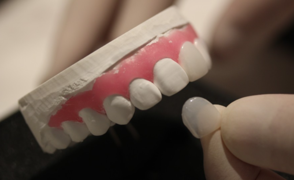 앞니라미네이트 치아삭제없는 무삭제라미네이트 블랙필름 관련 이미지 3