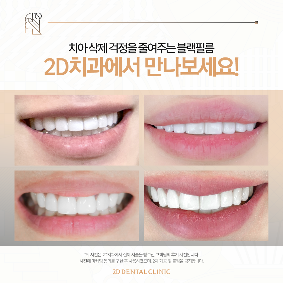 무삭제라미네이트부작용 앞니깨짐 블랙필름으로 걱정 줄이세요! 관련 이미지 6