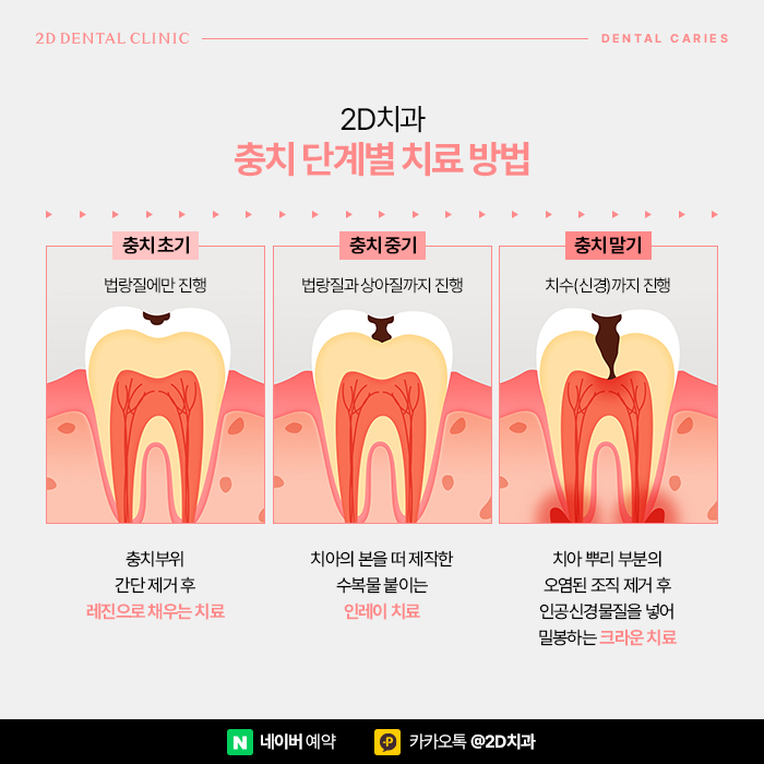 이빨썩음, 치아썩음 치과충치치료는 어떻게 할까? 선릉역치과에서 관련 이미지 5