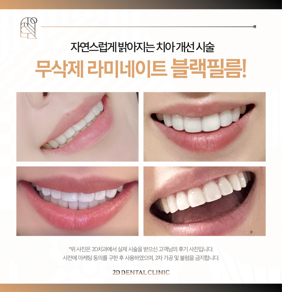 블랙필름 무삭제라미네이트로 앞니파절 치아미백 걱정 없어요 관련 이미지 8