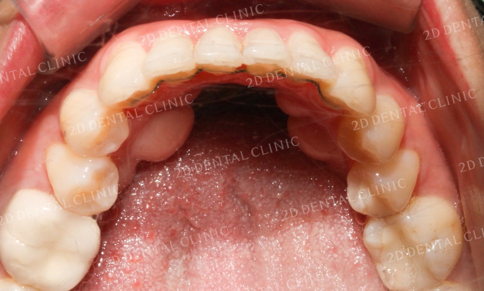 [앞니교정] 돌출앞니교정, 토끼앞니를 클리피씨교정으로 완성하기! by. 투디치과(2D치과) 관련 이미지 14