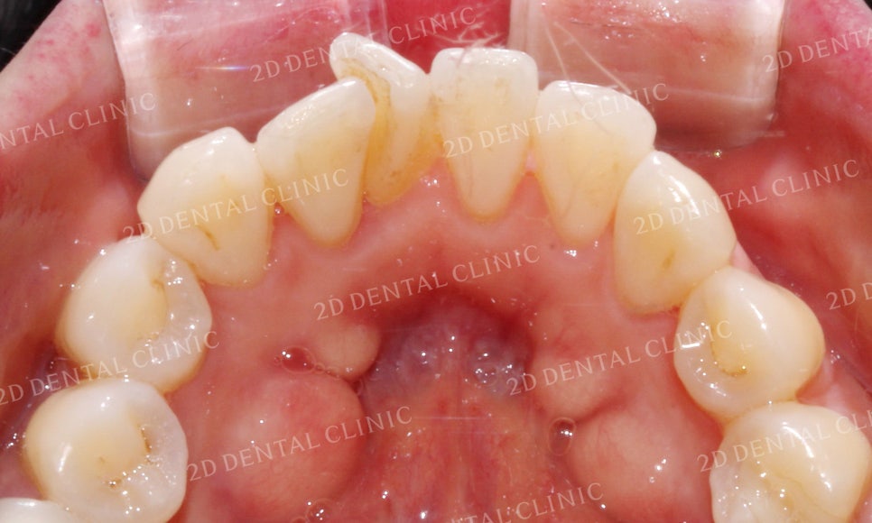 [앞니교정] 돌출앞니교정, 토끼앞니를 클리피씨교정으로 완성하기! by. 투디치과(2D치과) 관련 이미지 13