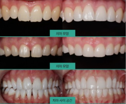 무삭제라미네이트부작용 블랙필름과 비교 관련 이미지 4