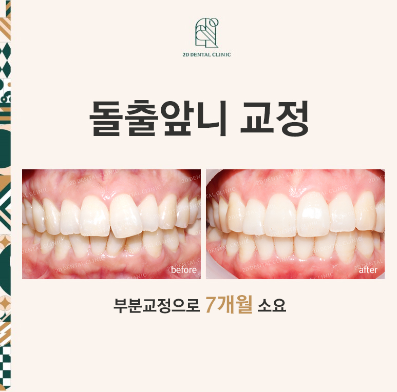 [앞니교정] 돌출앞니교정, 토끼앞니를 클리피씨교정으로 완성하기! by. 투디치과(2D치과) 관련 이미지 1