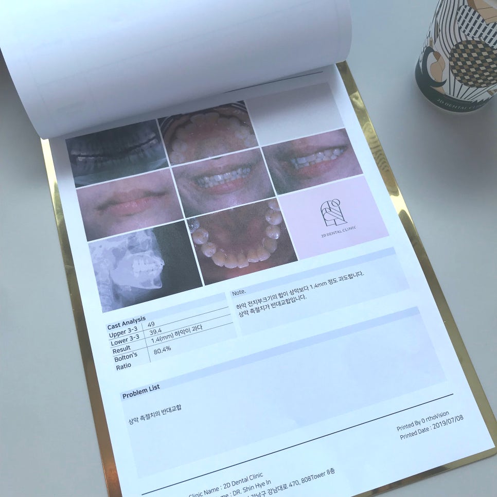 2D치과(투디치과) 교정일기ㅣ앞니덧니,반대교합 치아교정 완료!(ft.투디교정 전체교정) 관련 이미지 3