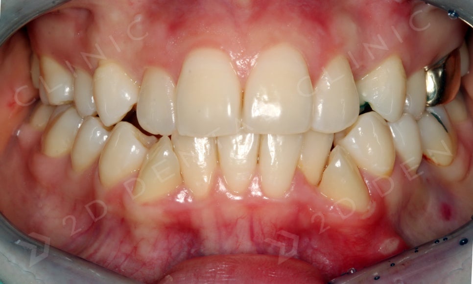 덧니만 부분교정으로 교정 할 수 있나요? 관련 이미지 9