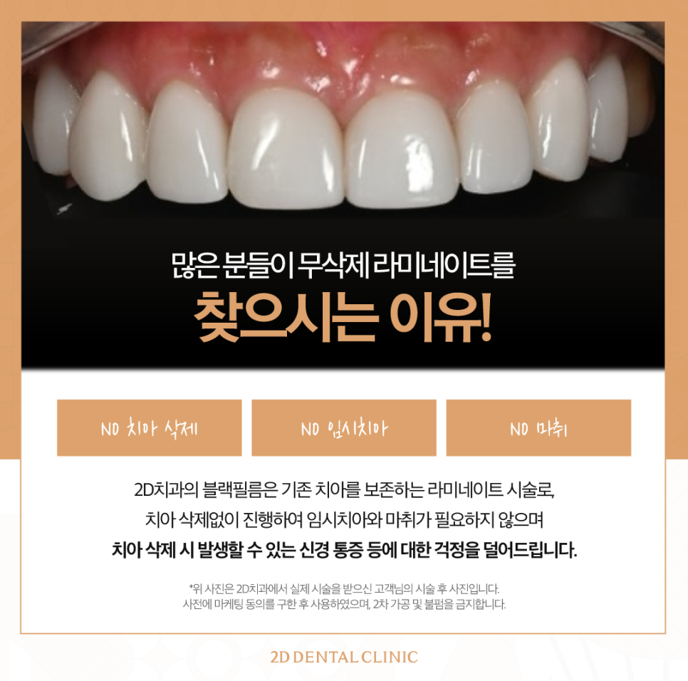 무삭제라미네이트후기 벌어진치아 해결하는 블랙필름 관련 이미지 3