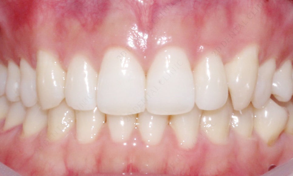 덧니치아 앞니교정 4개월 교정 완료! by. 투디치과(2D치과) 관련 이미지 9