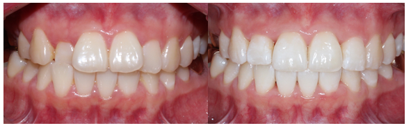 덧니 투명교정 8개월 치료 사례 관련 이미지 15