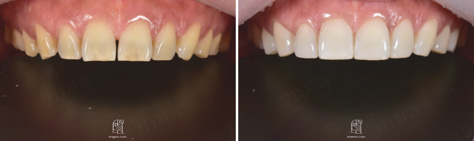 강남라미네이트치과 추천 : 진짜 무삭제, 투디치과! 관련 이미지 14