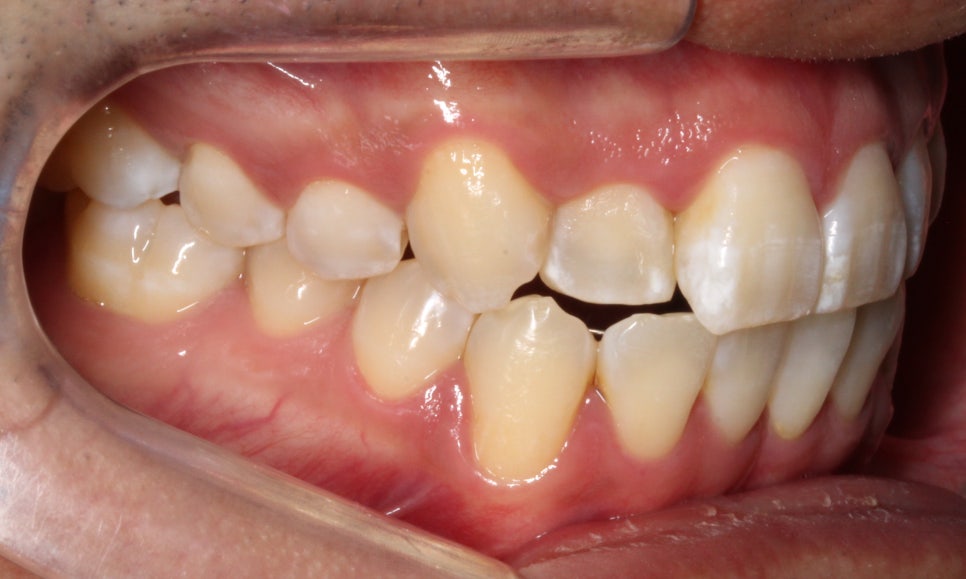 앞니 덧니 고민, 부분 설측 교정으로 해결한 사례 관련 이미지 6